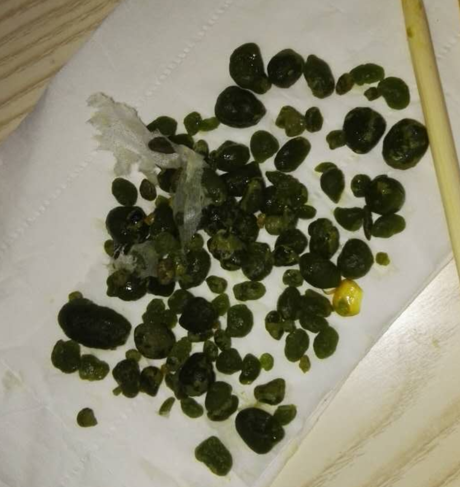 谢国和医师体内环保排出的肝胆结石前驱物照片