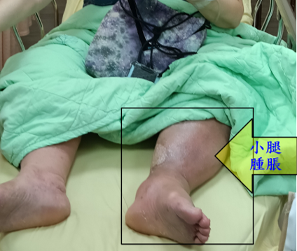 摄于2025/8/25急诊室，小腿肿得很大且已开始变黑
